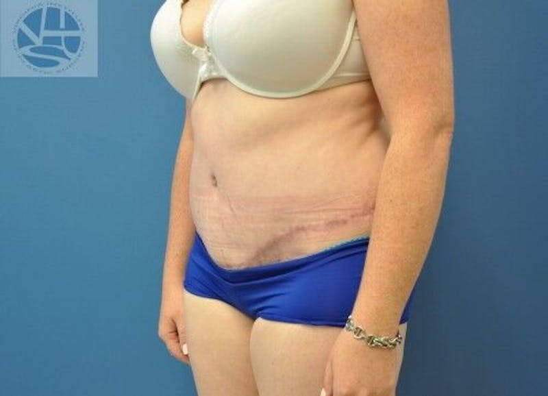 Tummy Tuck Before & After Gallery - Patient 55345345 - Image 4