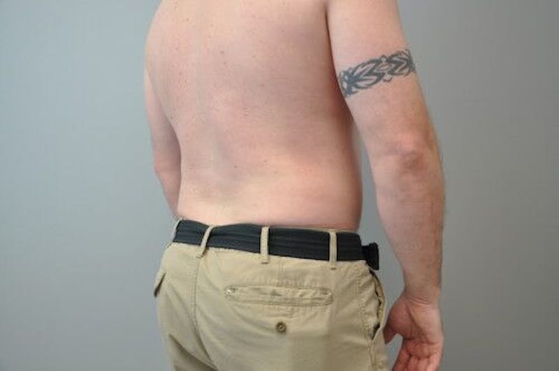 Liposuction Before & After Gallery - Patient 211876592 - Image 14