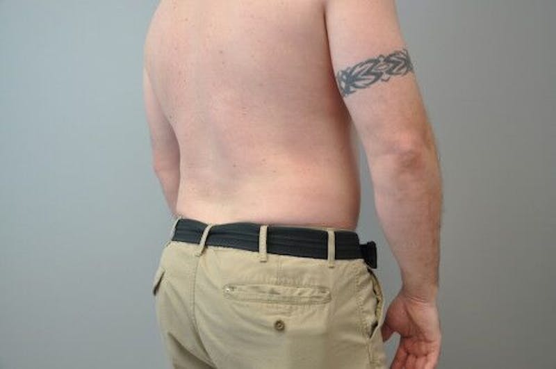 Liposuction Before & After Gallery - Patient 55345341 - Image 14