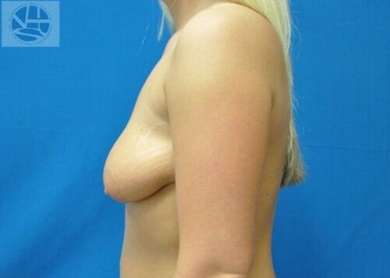 Breast Augmentation with Lift Before & After Gallery - Patient 55345343 - Image 7