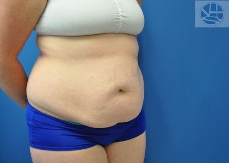 Tummy Tuck Before & After Gallery - Patient 55345345 - Image 5