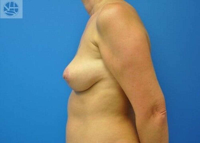 Breast Lift Before & After Gallery - Patient 55345340 - Image 10
