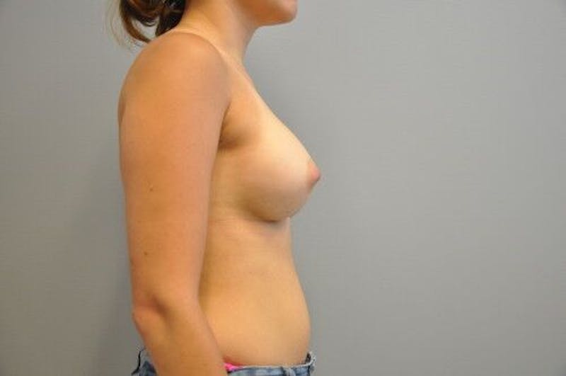 Breast Augmentation Before & After Gallery - Patient 55345344 - Image 6