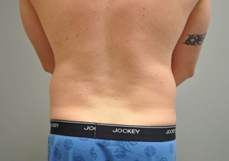 Liposuction Before & After Gallery - Patient 211876592 - Image 15