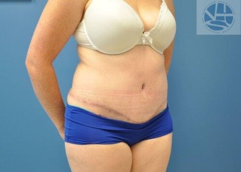Tummy Tuck Before & After Gallery - Patient 55345345 - Image 6