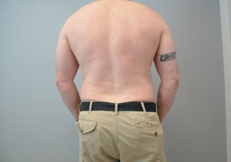 Liposuction Before & After Gallery - Patient 211876592 - Image 16