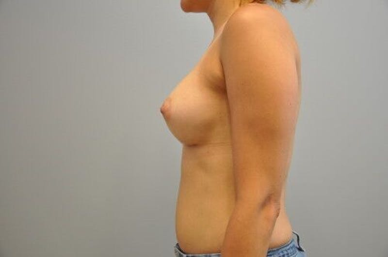 Breast Augmentation Before & After Gallery - Patient 55345344 - Image 8
