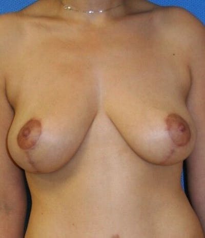 Breast Lift Gallery - Patient 55345346 - Image 2