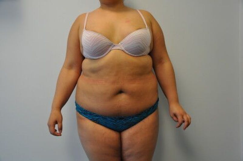 Liposuction Before & After Gallery - Patient 211876591 - Image 1