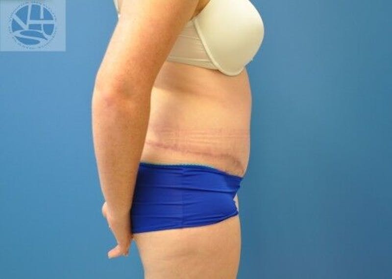 Tummy Tuck Before & After Gallery - Patient 55345345 - Image 8