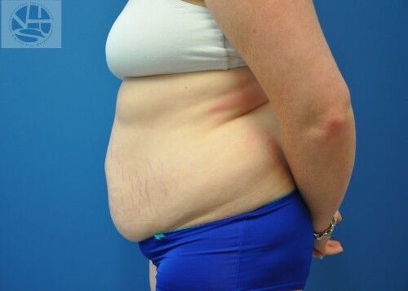 Tummy Tuck Before & After Gallery - Patient 55345345 - Image 9