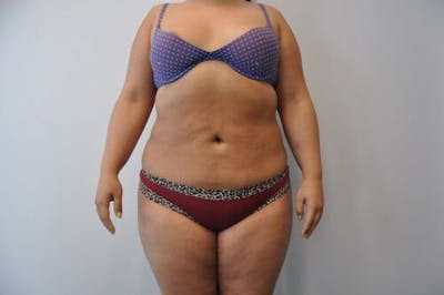Liposuction Gallery - Patient 55345350 - Image 2