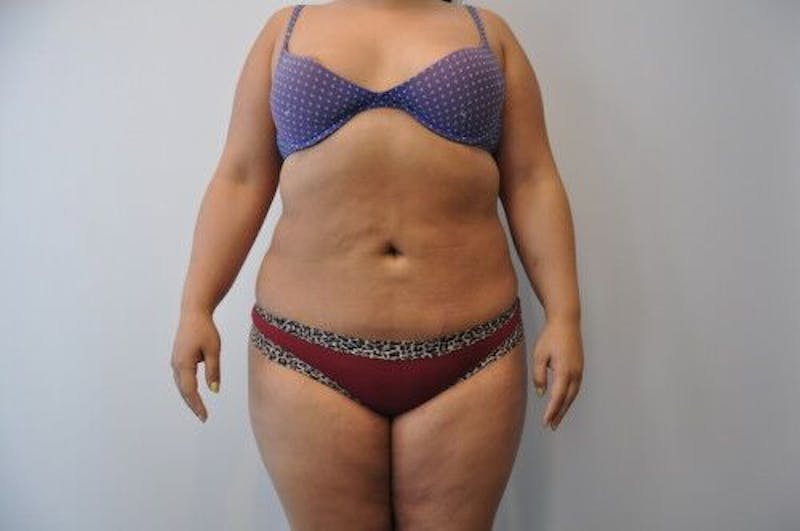 Liposuction Before & After Gallery - Patient 55345350 - Image 2