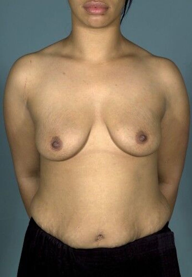 Breast Augmentation with Lift Before & After Gallery - Patient 55345356 - Image 1