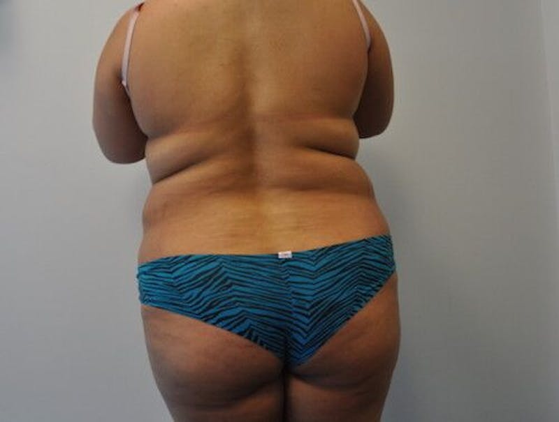 Liposuction Before & After Gallery - Patient 55345350 - Image 3