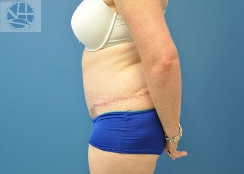 Tummy Tuck Before & After Gallery - Patient 55345345 - Image 10
