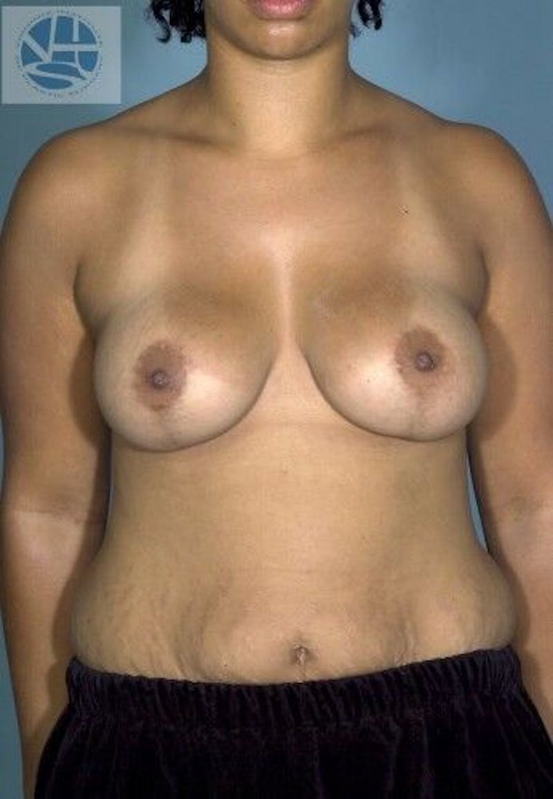 Breast Augmentation with Lift Before & After Gallery - Patient 55345356 - Image 2