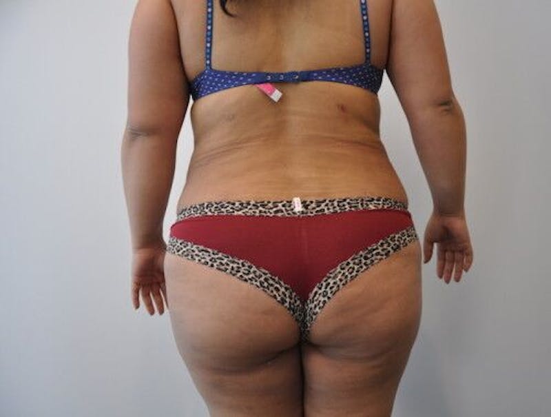 Liposuction Before & After Gallery - Patient 55345350 - Image 4