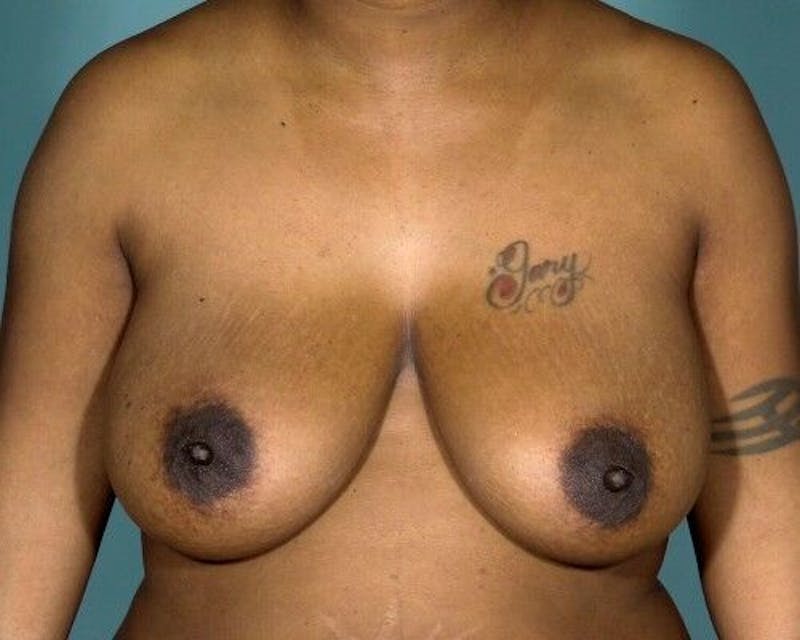 Breast Lift Before & After Gallery - Patient 55345352 - Image 1