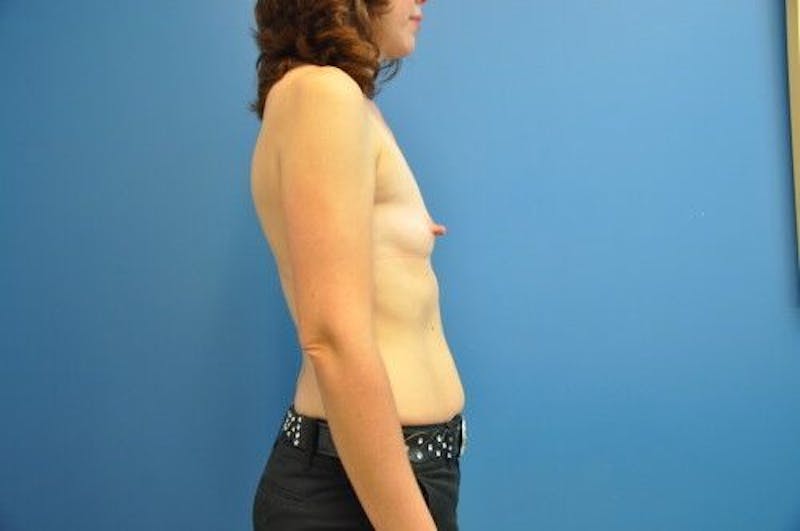 Breast Augmentation Before & After Gallery - Patient 55345353 - Image 3