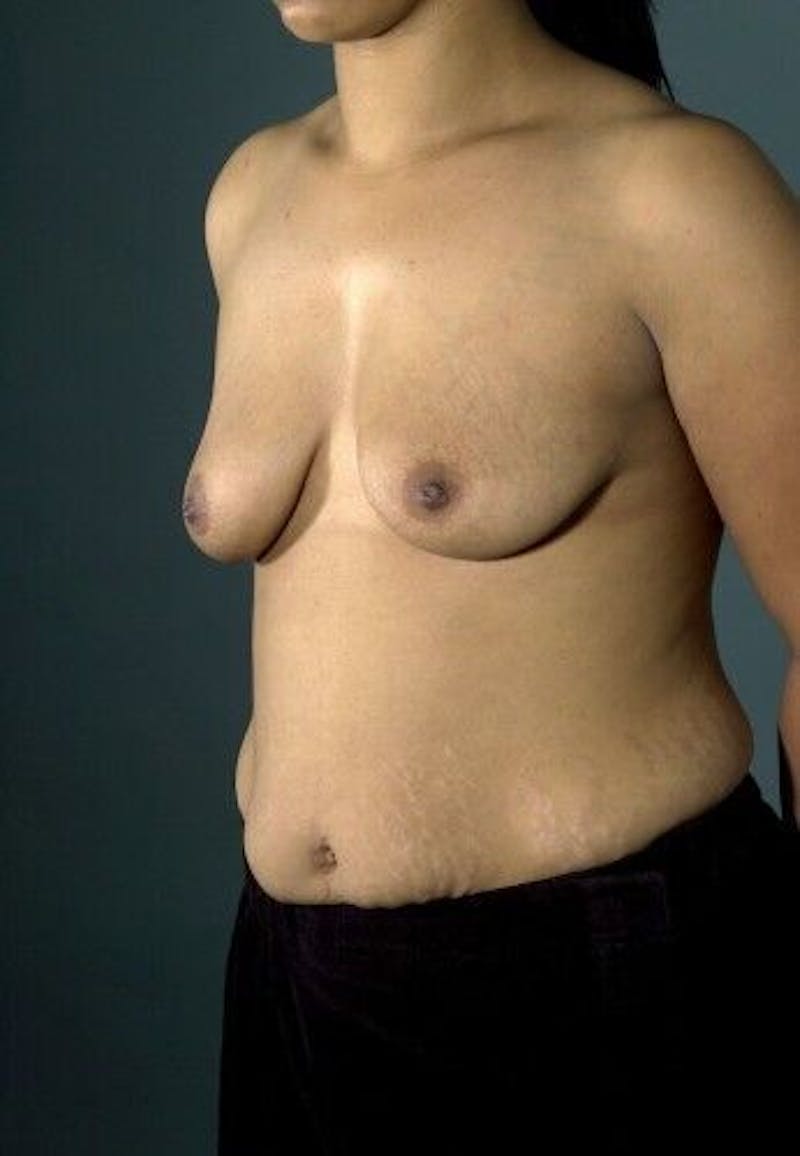 Breast Augmentation with Lift Before & After Gallery - Patient 55345356 - Image 3