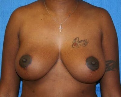Breast Lift Before & After Gallery - Patient 55345352 - Image 2