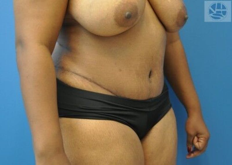Tummy Tuck Before & After Gallery - Patient 55345357 - Image 4