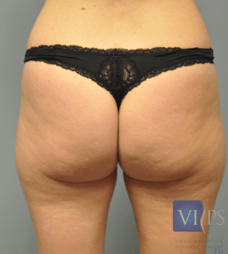 Liposuction Before & After Gallery - Patient 55345354 - Image 1