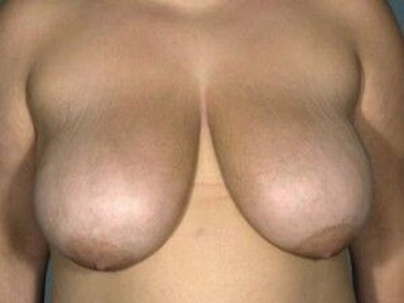 Breast Lift Before & After Gallery - Patient 55345358 - Image 1