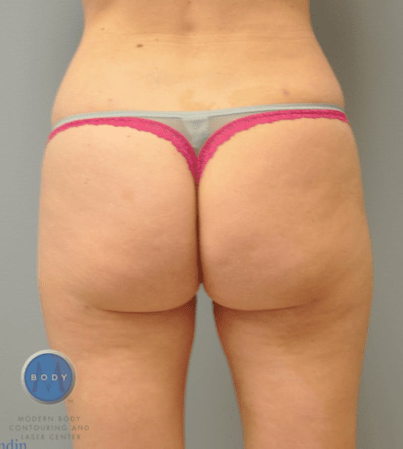 Liposuction Before & After Gallery - Patient 55345354 - Image 2