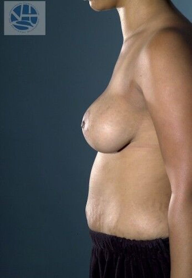 Breast Augmentation with Lift Before & After Gallery - Patient 55345356 - Image 8