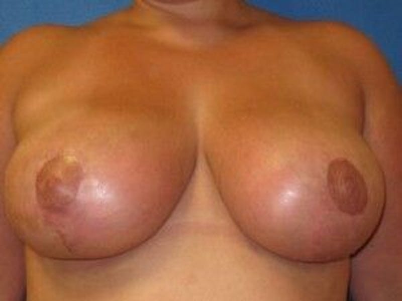 Breast Lift Before & After Gallery - Patient 55345358 - Image 2