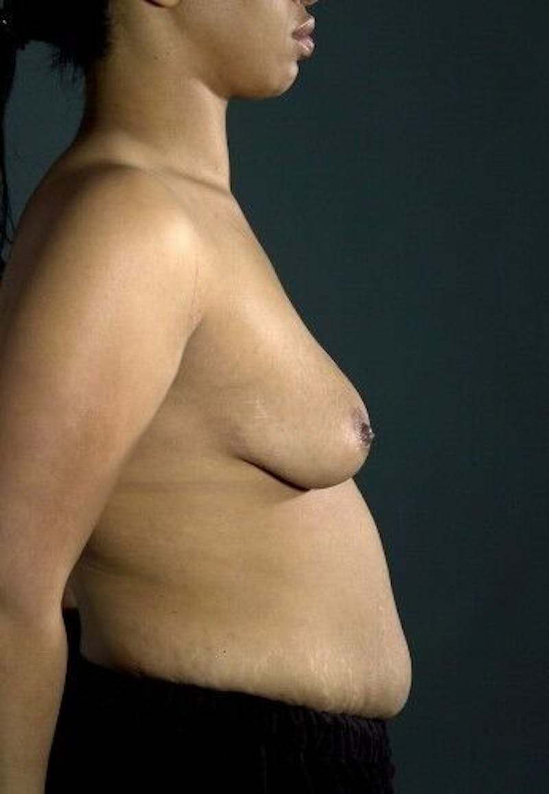 Breast Augmentation with Lift Before & After Gallery - Patient 55345356 - Image 9