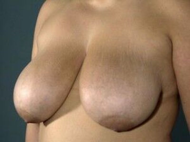 Breast Lift Before & After Gallery - Patient 55345358 - Image 3