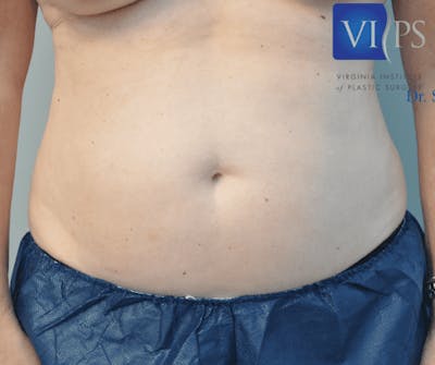 Renuvion J-Plasma Before & After Gallery - Patient 211876542 - Image 1