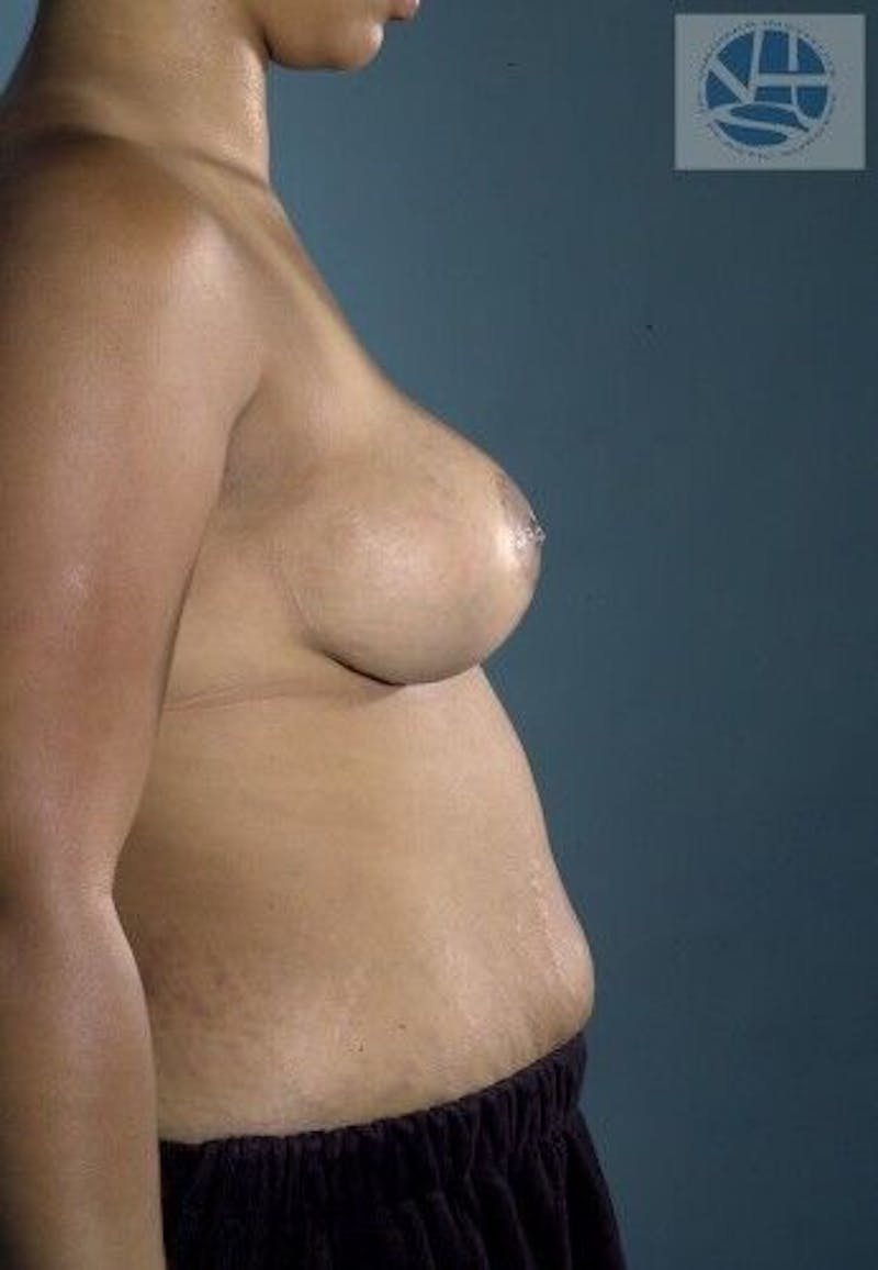 Breast Augmentation with Lift Before & After Gallery - Patient 55345356 - Image 10