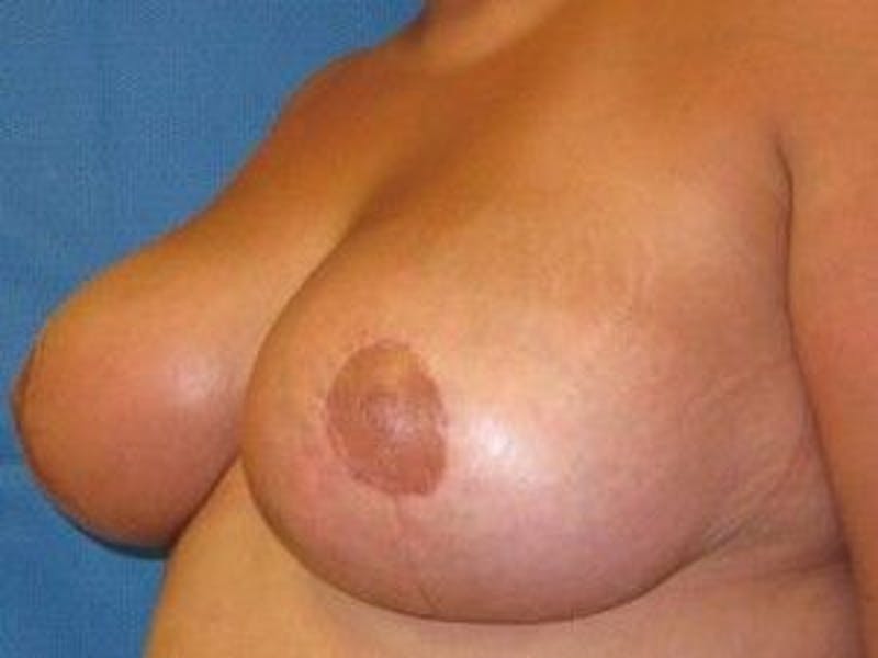 Breast Lift Before & After Gallery - Patient 55345358 - Image 4