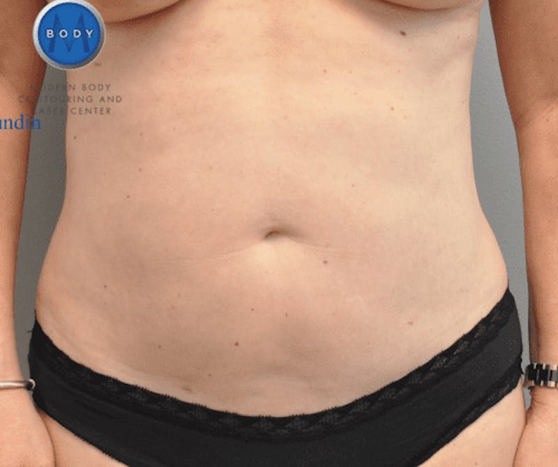 Liposuction Before & After Gallery - Patient 211876581 - Image 2