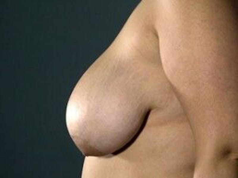 Breast Lift Before & After Gallery - Patient 55345358 - Image 5