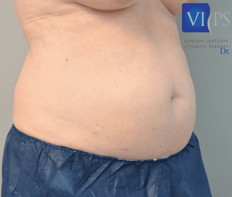 Liposuction Before & After Gallery - Patient 211876581 - Image 3