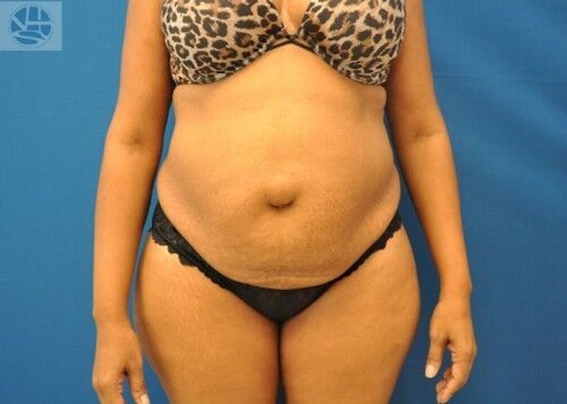 Tummy Tuck Before & After Gallery - Patient 55345363 - Image 1