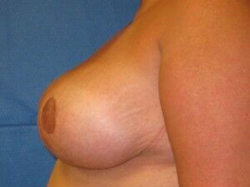 Breast Lift Before & After Gallery - Patient 55345358 - Image 6