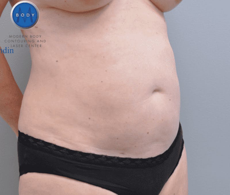 Liposuction Before & After Gallery - Patient 211876581 - Image 4