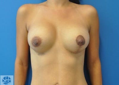 Breast Augmentation with Lift Gallery - Patient 55345362 - Image 2