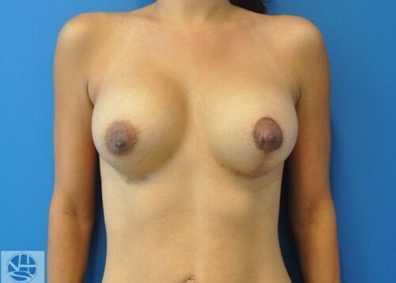 Breast Augmentation with Lift Before & After Gallery - Patient 55345362 - Image 2