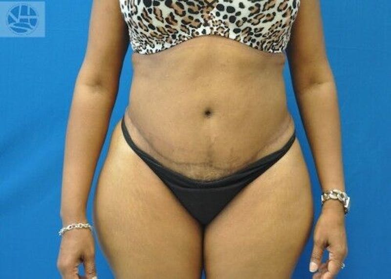 Tummy Tuck Before & After Gallery - Patient 55345363 - Image 2