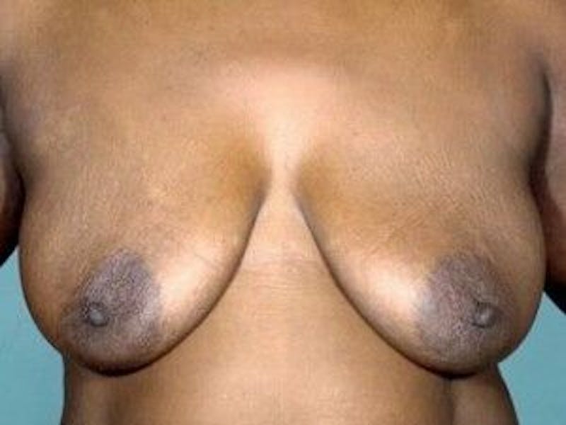 Breast Lift Before & After Gallery - Patient 55345361 - Image 1