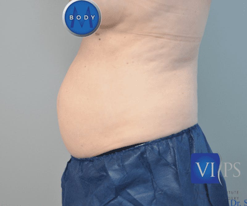 Liposuction Before & After Gallery - Patient 211876581 - Image 5
