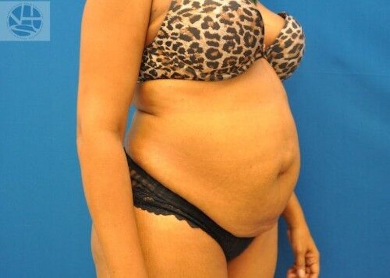 Tummy Tuck Before & After Gallery - Patient 55345363 - Image 3