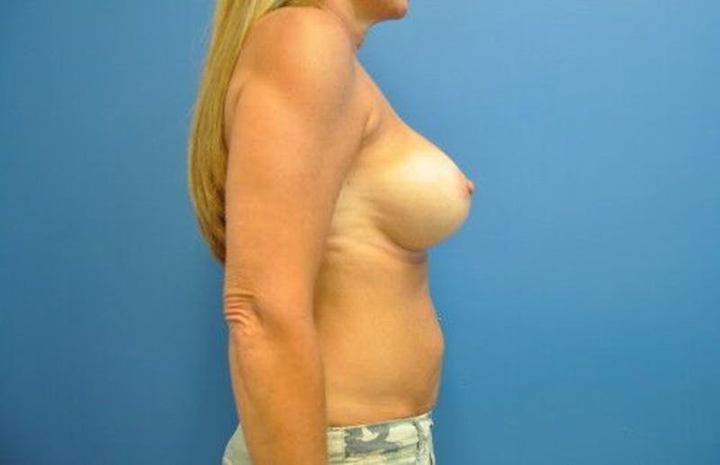 Breast Augmentation Before & After Gallery - Patient 55345359 - Image 8
